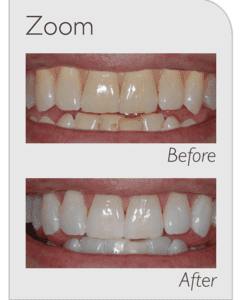 Zoom Before and After