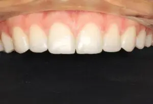 Banyule Dental After Invisalign treatment