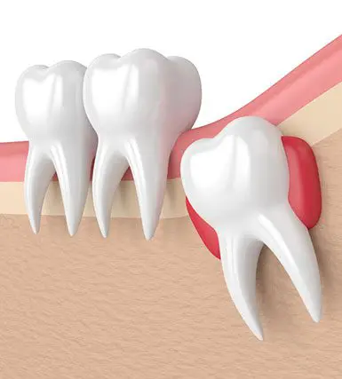 Banyule Dental Wisdom teeth extraction Greensborough