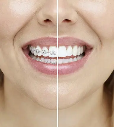 Banyule Dental Orthodontic Invisalign