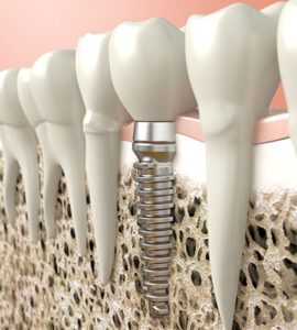 Dental Implants Banyule Dental