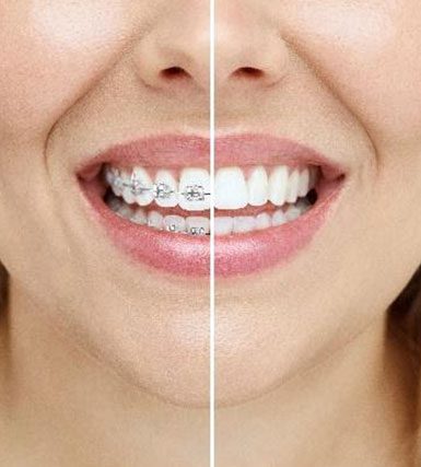 Orthodontics Treatment Banyule Dental