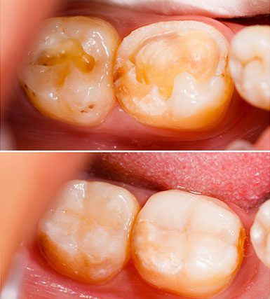 Tooth Coloured Fillings Banyule Dental