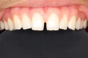 Banyule Dental Before Invisalign treatment