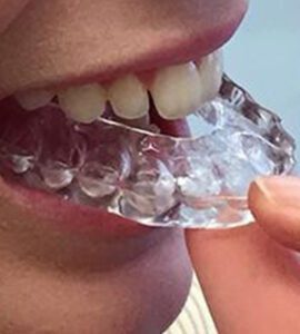 Banyule Dental Occlusal Device Greensborough