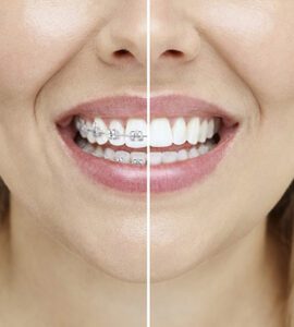 braces-and-invisalign-banyule-dental