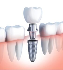 implants-banyule-dental