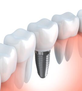 Dental-Implants-Greensborough