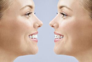 Banyule Dental comparison of metal braces and Invisalign clear aligner
