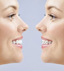 Banyule Dental comparison of metal braces and Invisalign clear aligner