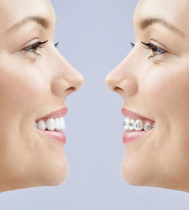 Banyule Dental comparison of metal braces and Invisalign clear aligner