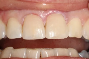 Front teeth cosmetic restoration after image at Banyule Dental.
