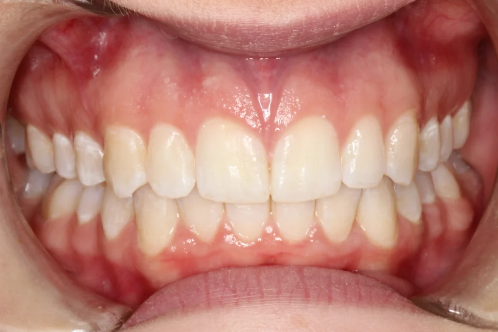 After image of a front tooth gap closure treatment at Banyule Dental.