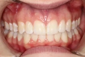 After image of a front tooth gap closure treatment at Banyule Dental.