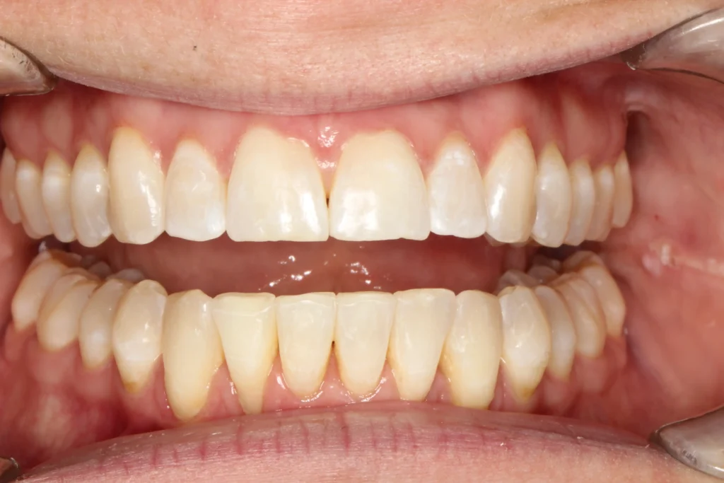 After teeth straightening transformation by Banyule Dental.