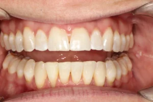 After teeth straightening transformation by Banyule Dental.