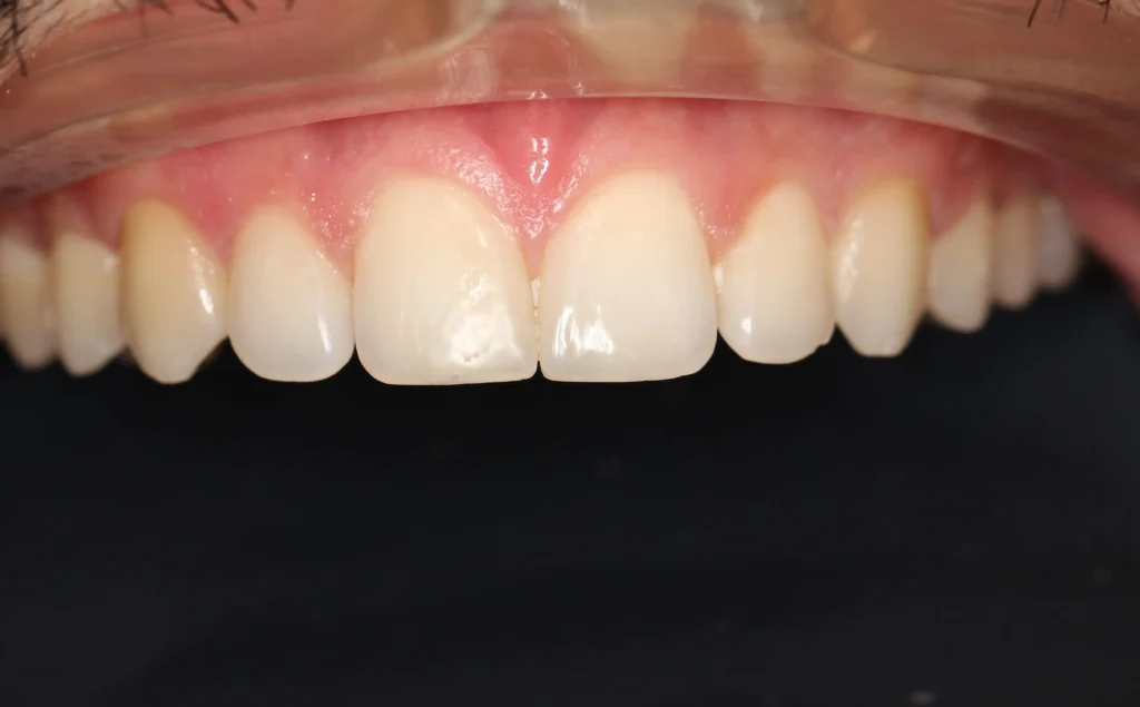 After cosmetic repair for chipped front teeth at Banyule Dental.