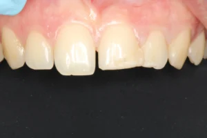 After cosmetic repair for broken front teeth at Banyule Dental.
