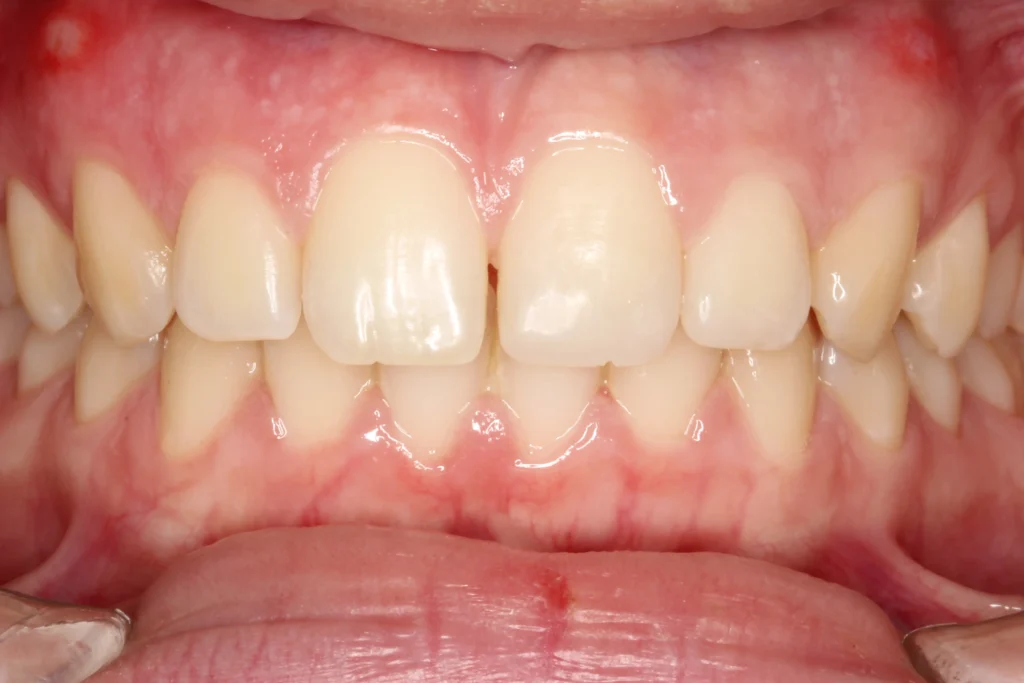 After front tooth gap closure treatment at Banyule Dental.