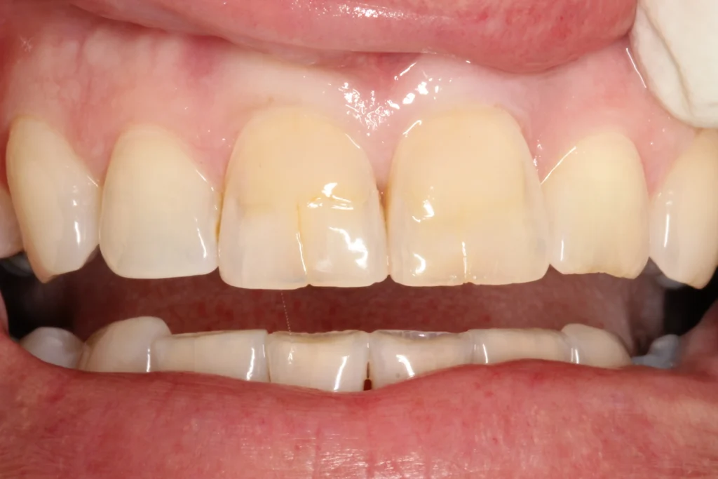 Front teeth cosmetic restoration before image at Banyule Dental.