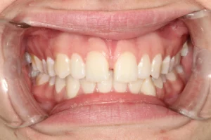 Before image of a front tooth gap closure treatment at Banyule Dental.