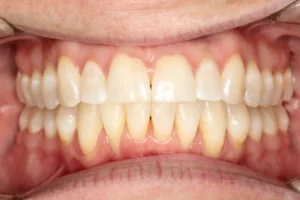 Before teeth straightening transformation by Banyule Dental.