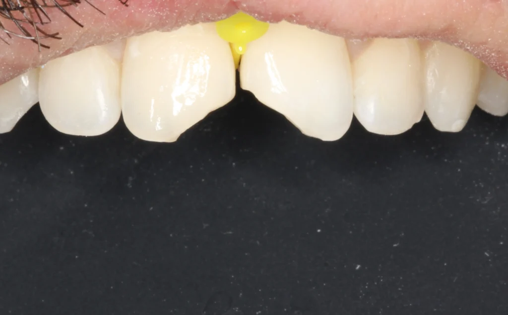 Before cosmetic repair for chipped front teeth at Banyule Dental.
