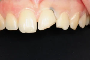 Before cosmetic repair for broken front teeth at Banyule Dental.