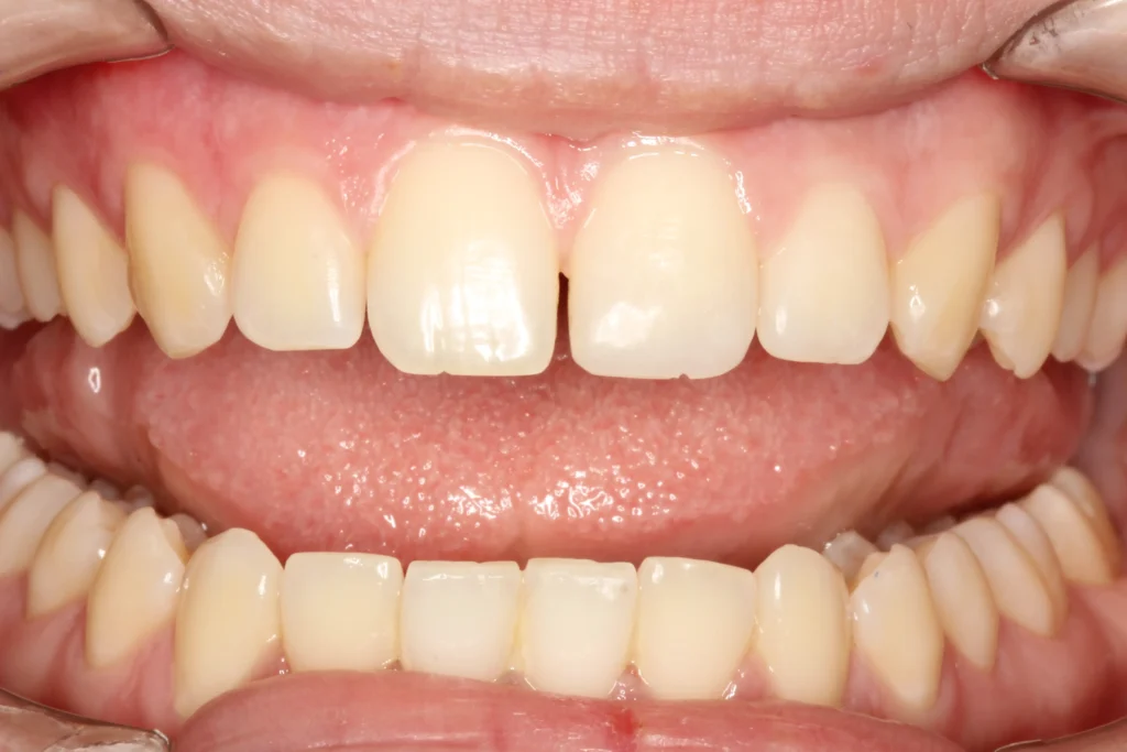 Before front tooth gap closure treatment at Banyule Dental.