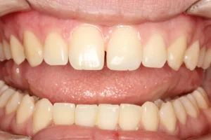 Before front tooth gap closure treatment at Banyule Dental.